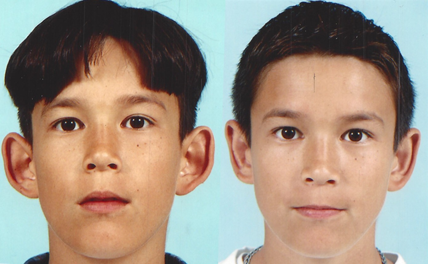 Dete pre i posle operacije klempavih ušiju