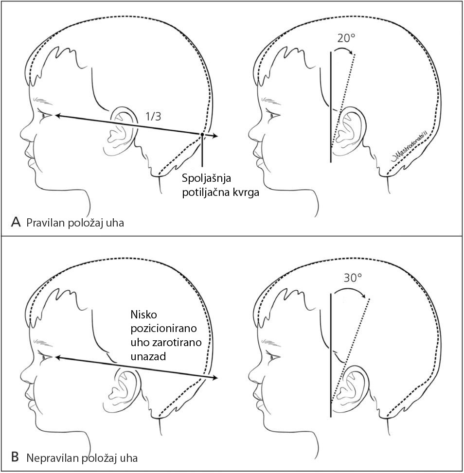 Grafički prikaz različitog položaja uha kod deteta