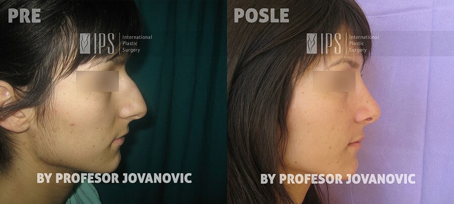 Operacija nosa - pre i posle, desni profil