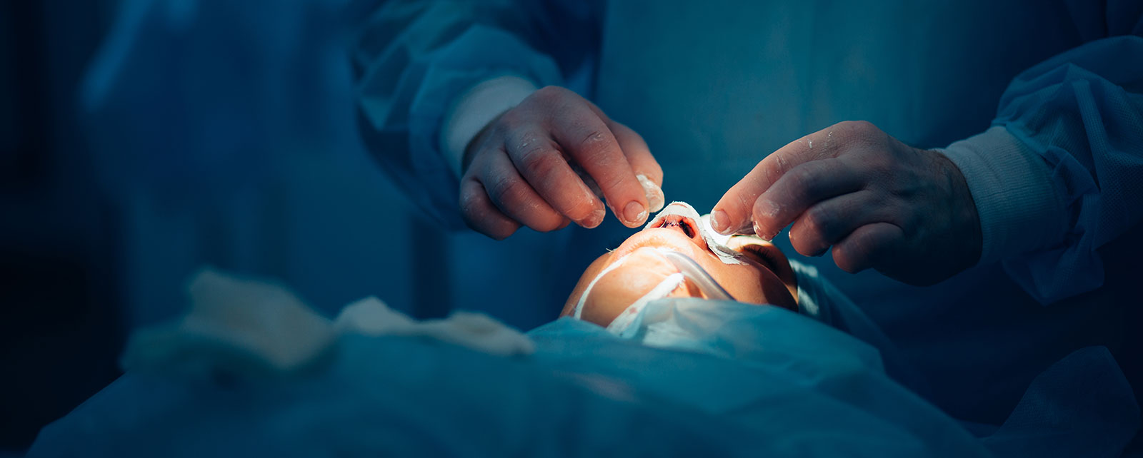 Rinoplastika se najčešće izvodi u opštoj anesteziji