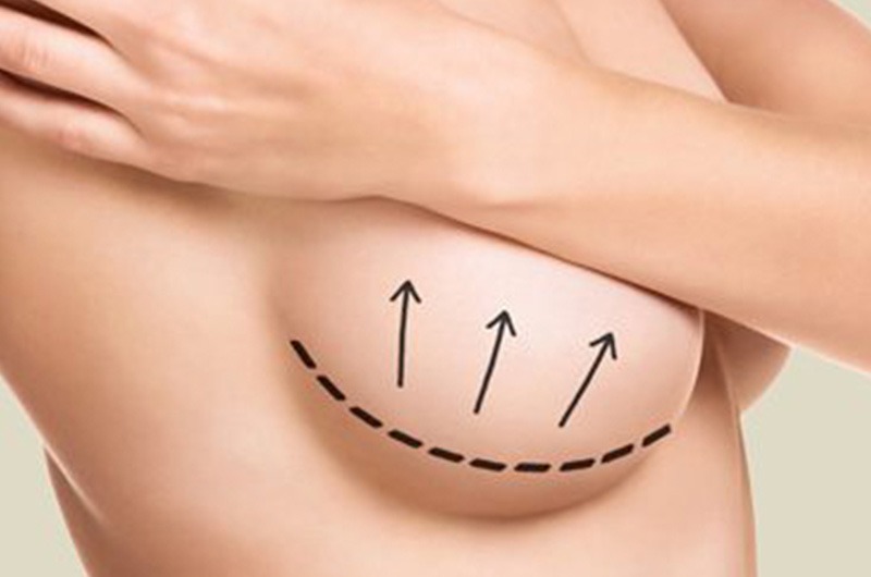 Podizanje i uvećanje dojki implantima
