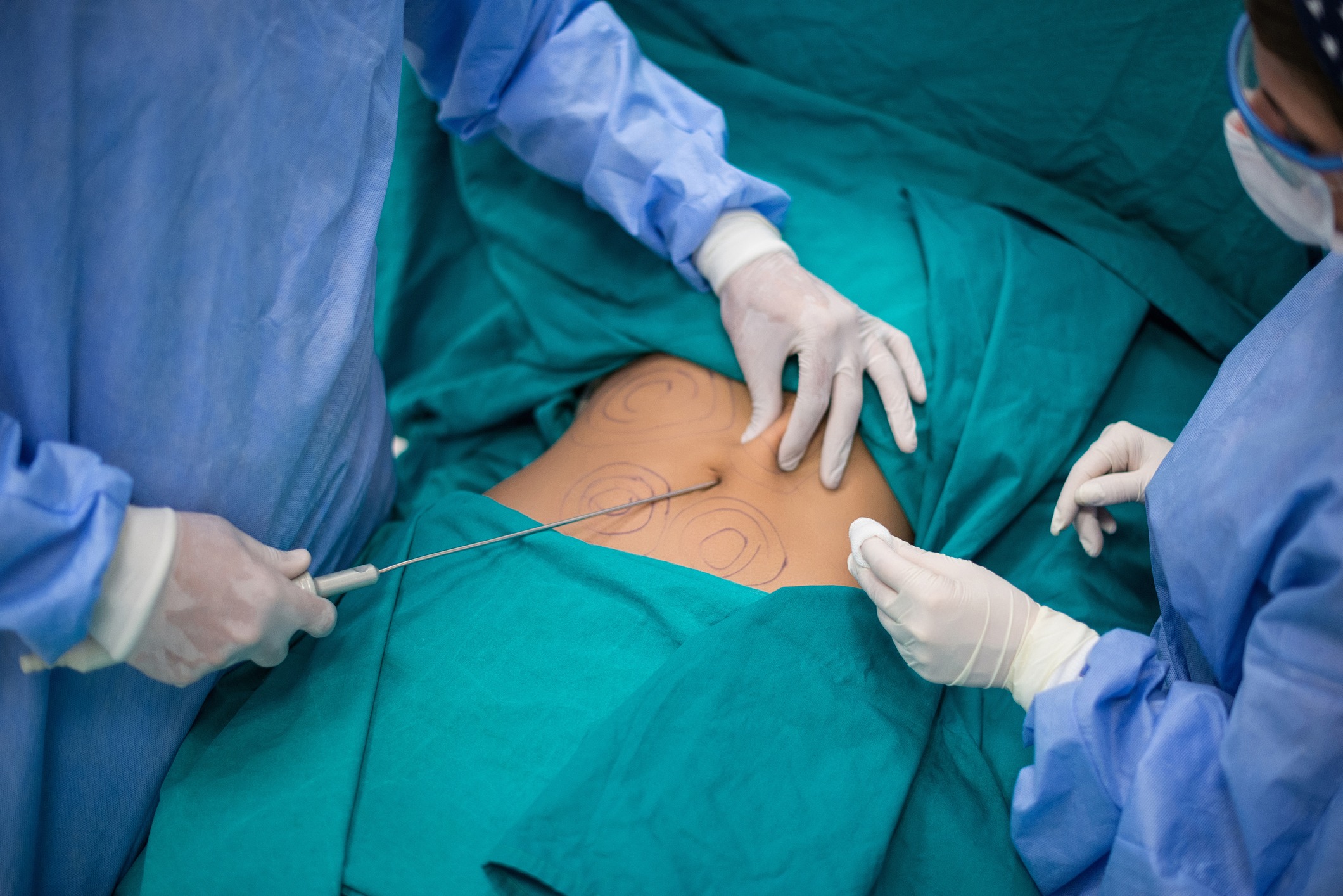 Operativna procedura liposukcije trbuha