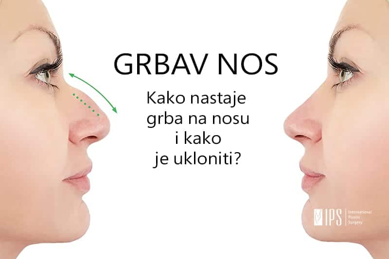 Nosna grba - kako ispraviti grbav nos?