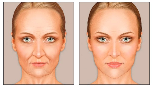 Lice žene pre i posle lipofilinga