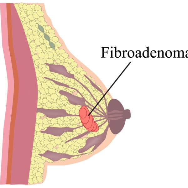 Fibroadenomi se uklanjaju hirurškim putem ukoliko izazivaju tegobe
