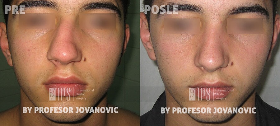 Operativni zahvat nad krivm nosem - pre i posle operacije