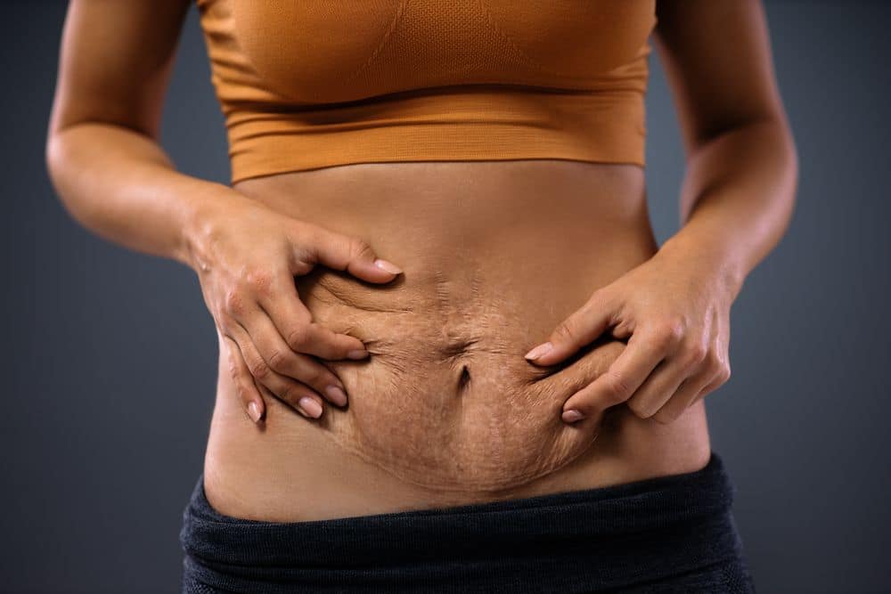 Zatezanje kože stomaka posle porođaja je potrebno nakon skidanja kilograma