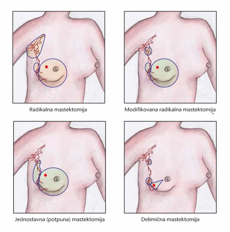 Plastični hirurg određuje izbor hirurške metode mastektomije dojke