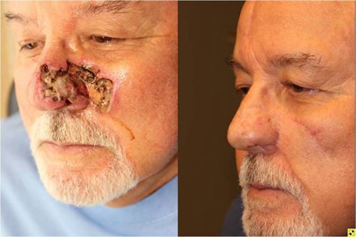 Uklanjanje tumora na nosu ostavlja posledice na ovom organu