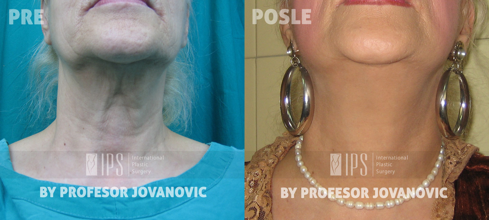 Face lifting - pre i posle