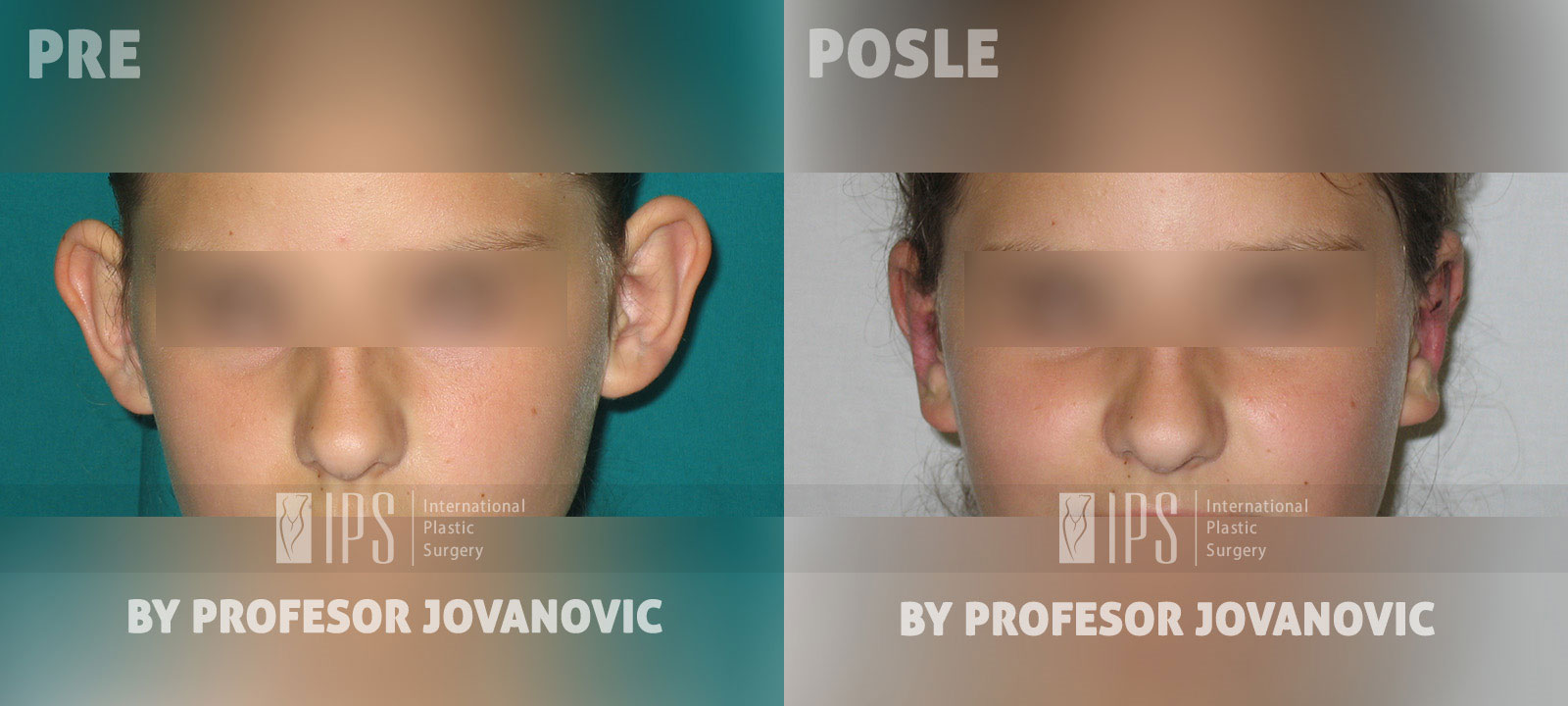 Operacija ušiju - pre i posle
