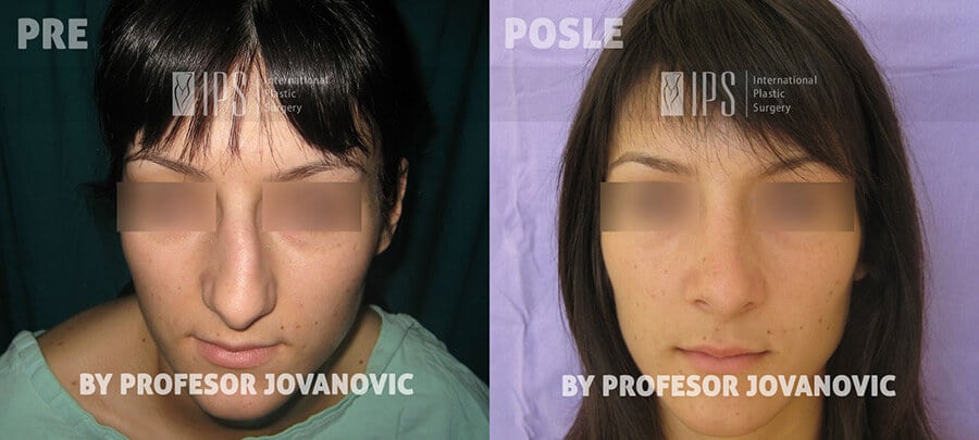 Operacija nosa - pre i posle, napred