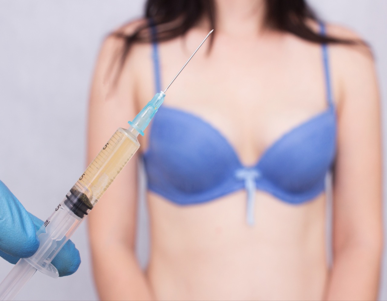 Lipofiling dojke - operativna tehnika