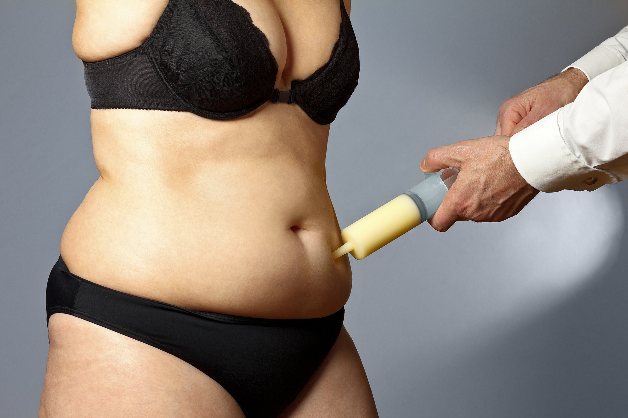 Liposukcija je isisavanje masnog tkiva