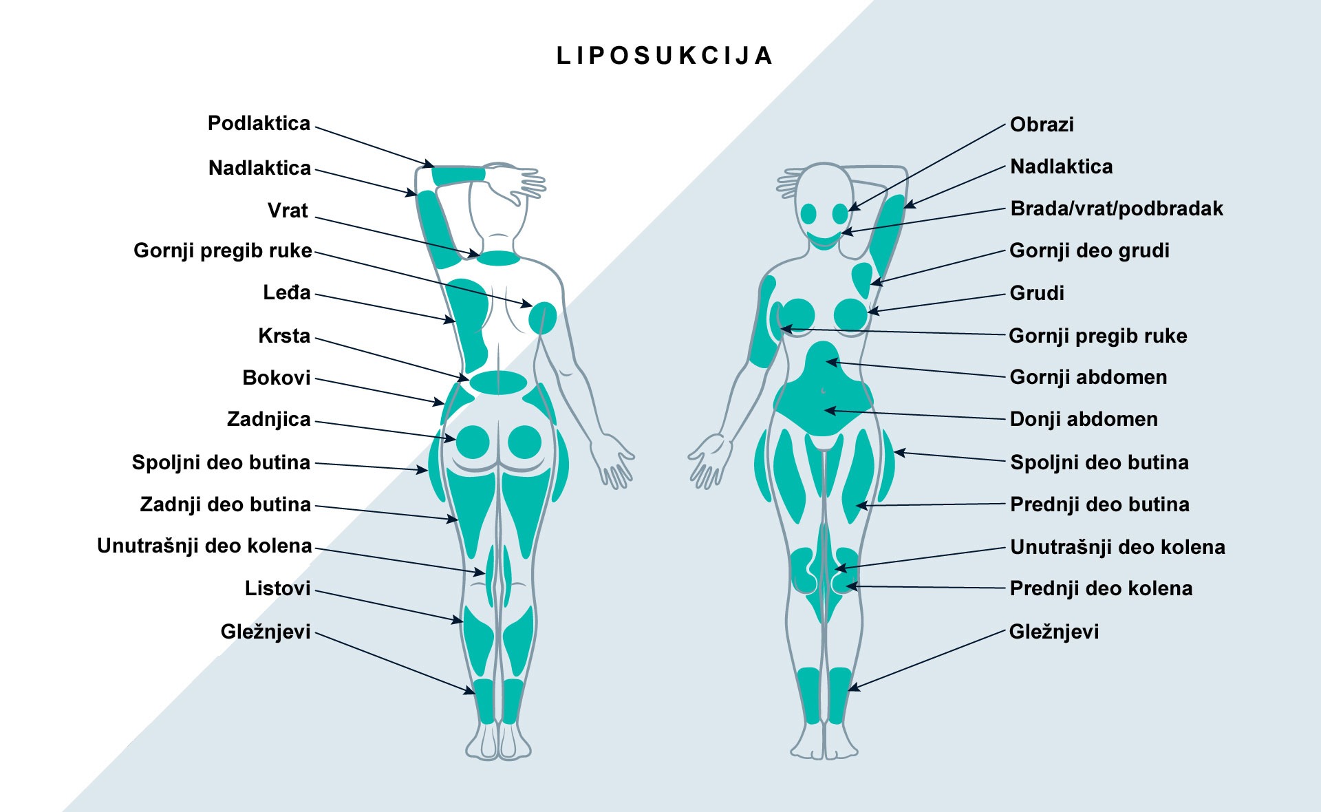 Liposukcija se najčešće radi na stomaku, podbratku, bradi, licu, rukama, nogama