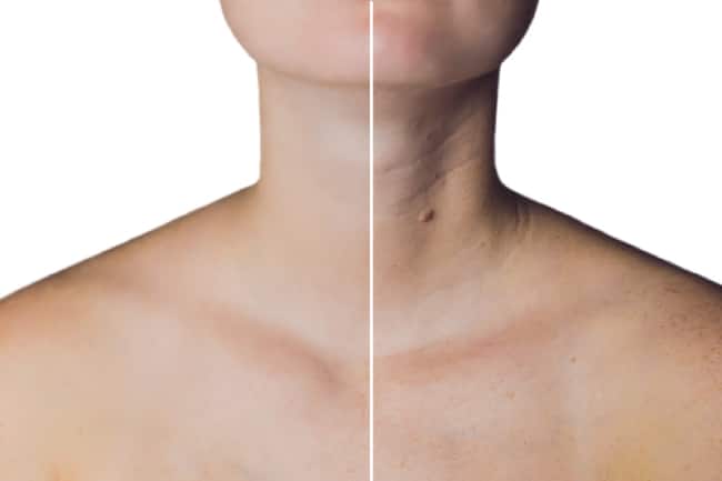 Kako izgleda koža vrata posle i pre tretmana podmlađivanja