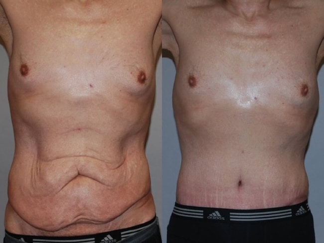 Slika muškog stomaka pre i posle liposukcije i zatezanja stomaka
