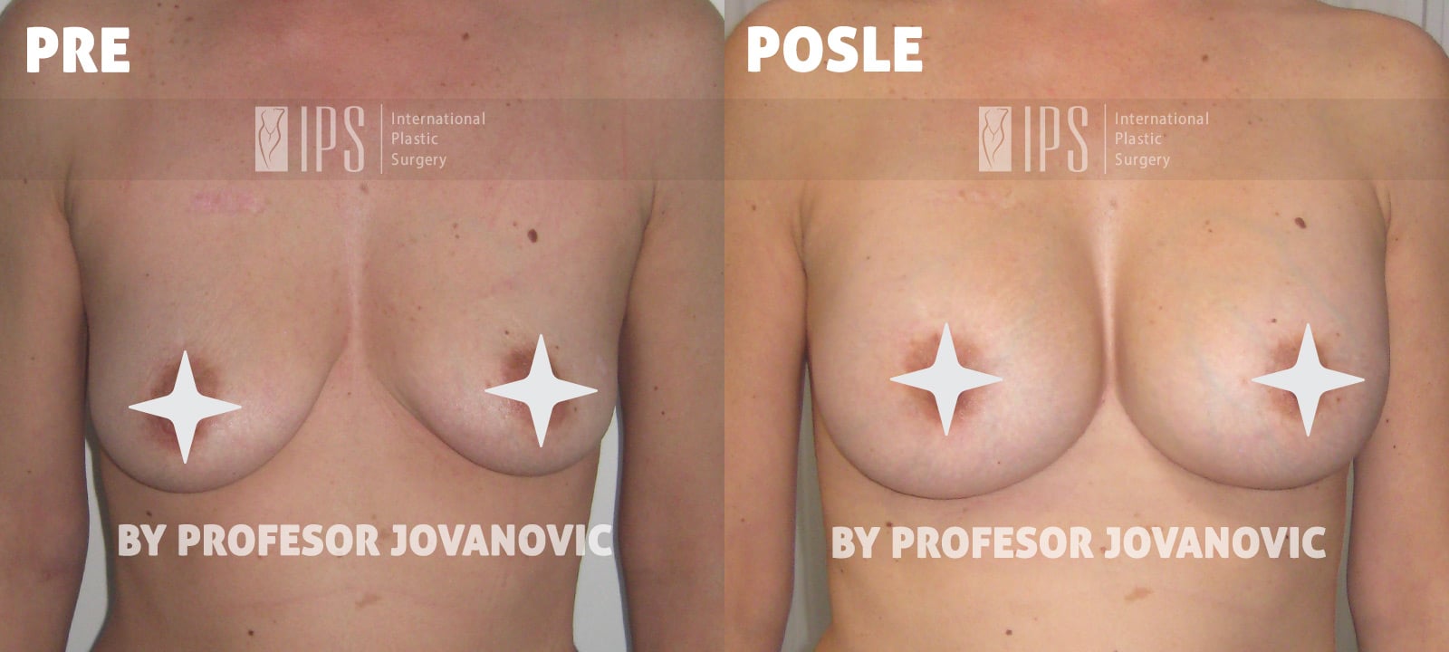 Ispravljanje asimetrije grudi i povećanje dojki – slike pre i posle