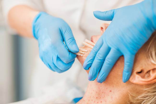 Mezoniti podižu i zatežu kožu