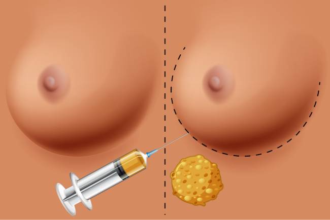 Uvećanje grudi uz fat transfer