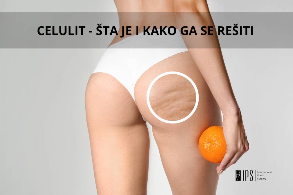 Celulit-kako skinuti celulit