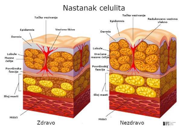 Nastajanje celulita u potkožnom tkivu