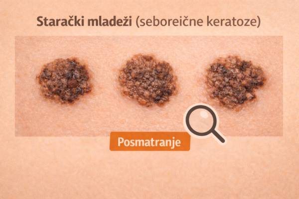 Starački mladeži keratoze