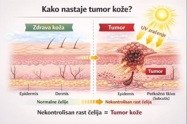 Kako nastaje tumor kože