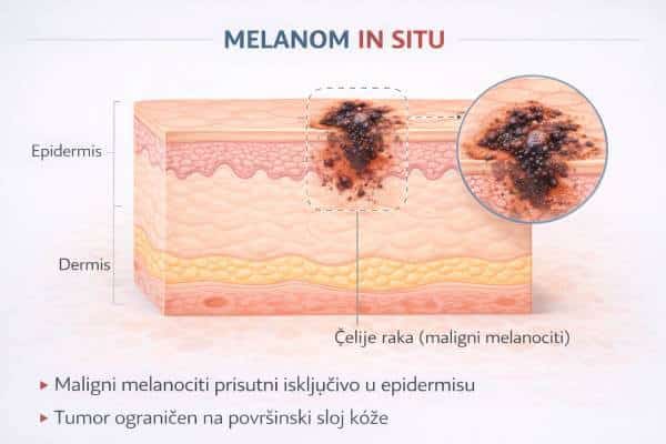 Melanom in situ
