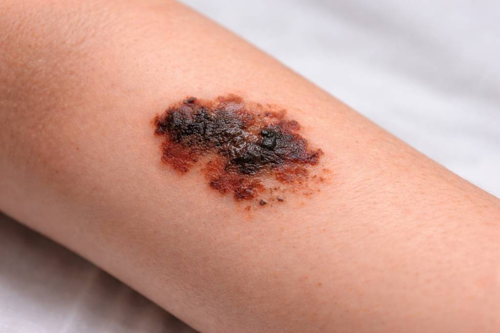 Kako nastaje melanom