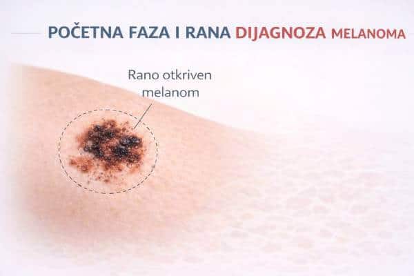 Početna faza melanoma