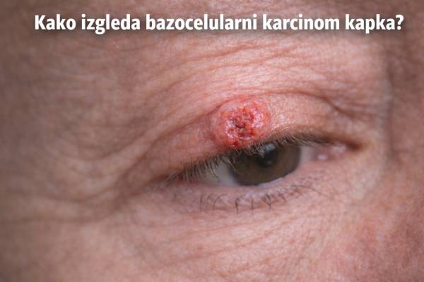 bazocelularni karcinom kapka