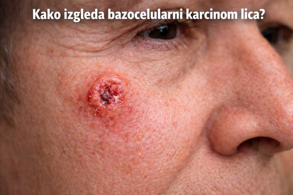 bazocelularni karcinom lica