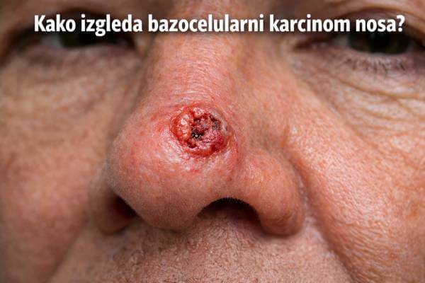 bazocelularni karcinom nosa