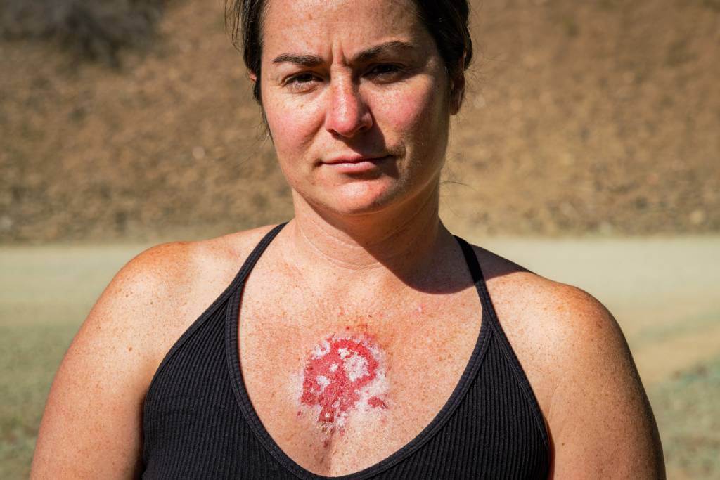 bazocelularni karcinom