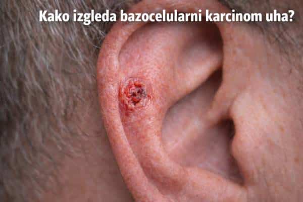 bazocelularni karcinom uha