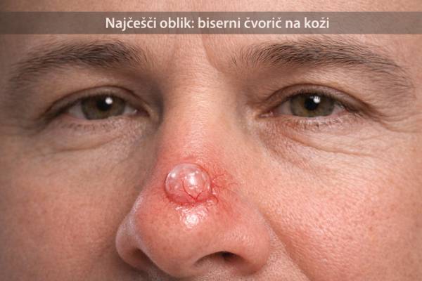 Nodularni bazocelularni karcinom na nosu sa bisernim čvorićem i vidljivim krvnim sudovima