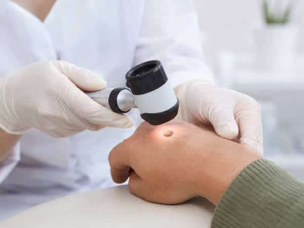 dermatološka procena virusne bradavice i izbor metode uklanjanja