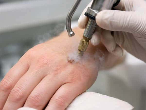 krioterapija tečnim azotom za uklanjanje virusne bradavice u dermatološkoj ordinaciji