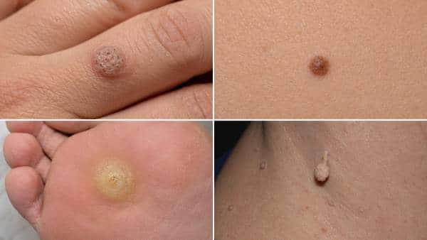 razlika između virusne bradavice mladeža kurjeg oka i fibroma na koži