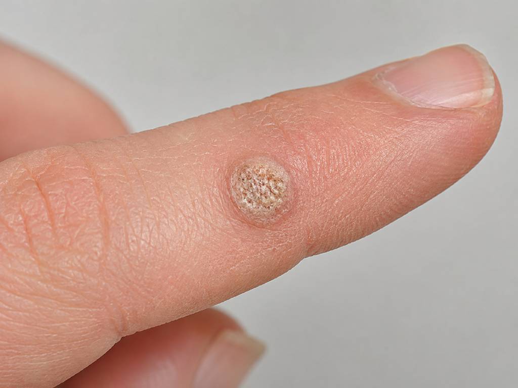 dermatološki pregled virusne bradavice na prstu
