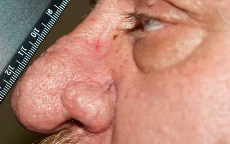 Paprikast nos je jedan od najružnijih tipova velikog nosa