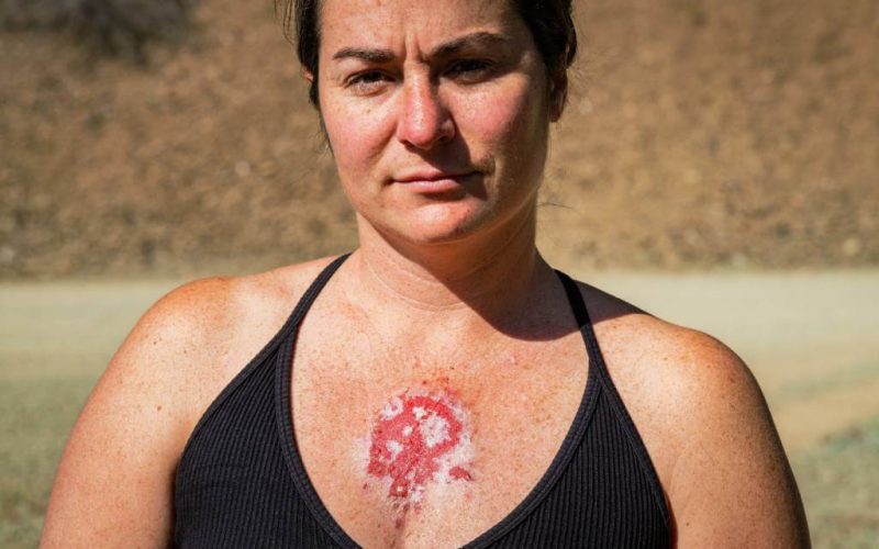 bazocelularni karcinom