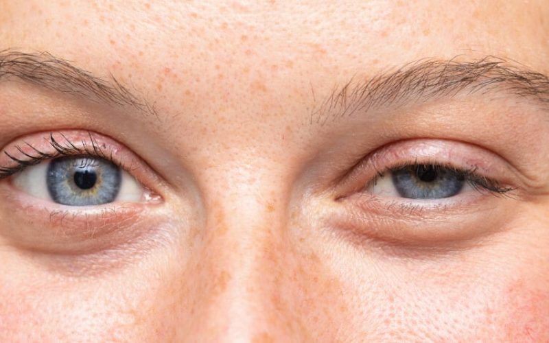 Simptomi Bernar-Hornerovog sindroma