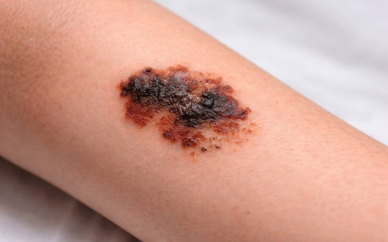 Kako nastaje melanom