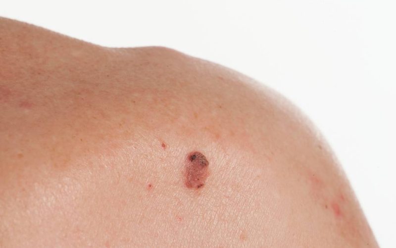Planocelularni karcinom - prikaz nastanka tumora u epidermisu