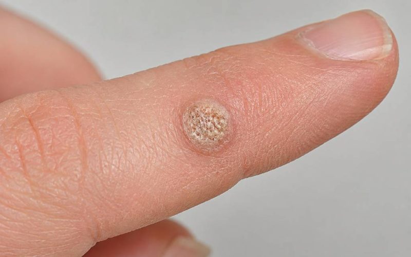 dermatološki pregled virusne bradavice na prstu